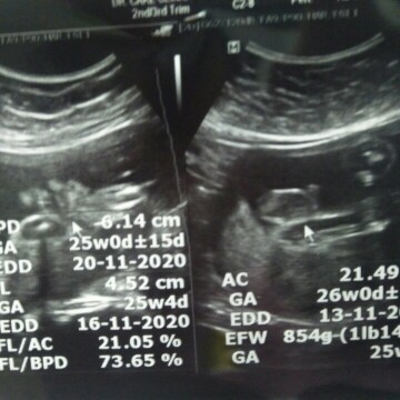 ตั้งครรภ์ 25 week 3 day