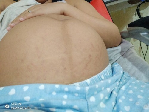 stretch marks