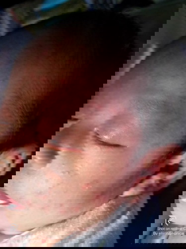 rashes o tigdas