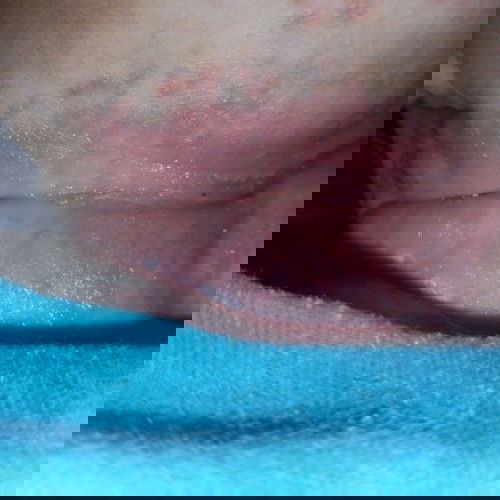 ruam merah lecet pada bagian leher bayi umur 3bln