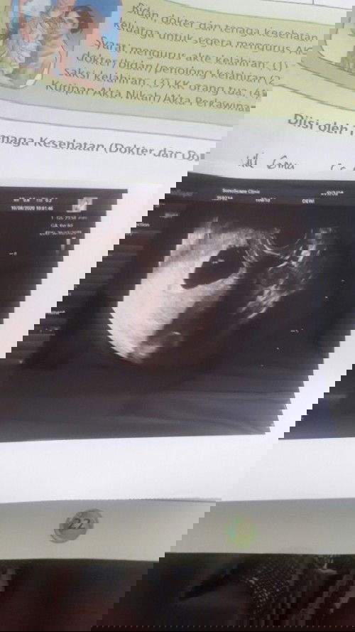 Usia bidan sama usg beda