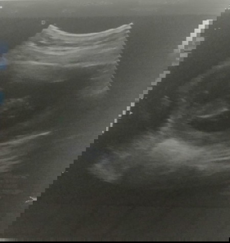 แท้งคุกคาม