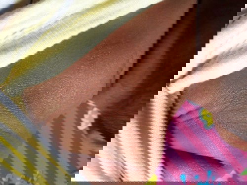 kulit kering pada bayi