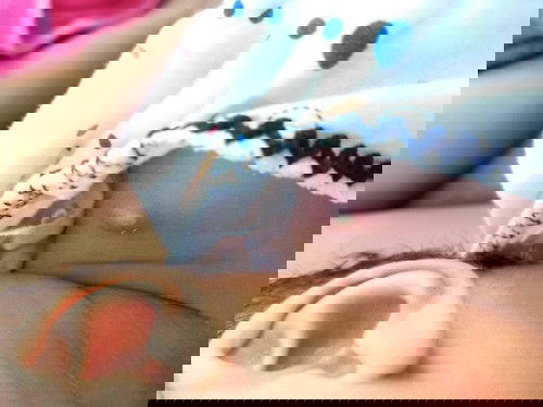 การรักษาปลูกฝี