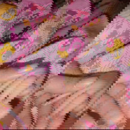 Hair Tourniquet or Congenital Condition