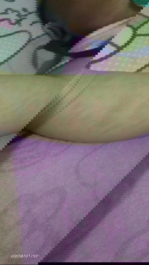 CAMPAK ATAU BIANG KERINGAT