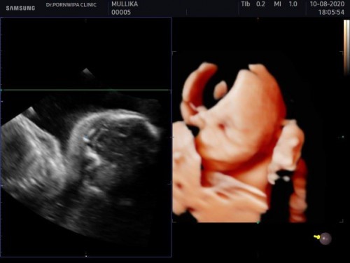 เด็กขี้อาย