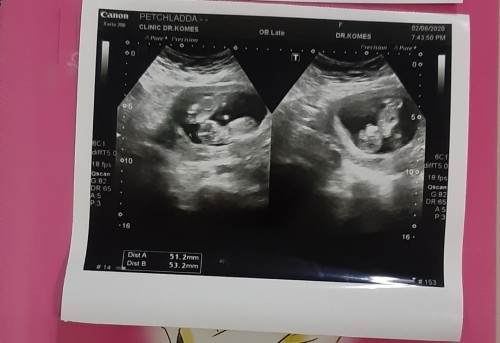 มีใครท้องลูกแฝดบ้างค่ะ