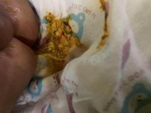 น้องถ่ายปนเลือดเส้นฝอยๆออกมาเกิดจากอะไร❓