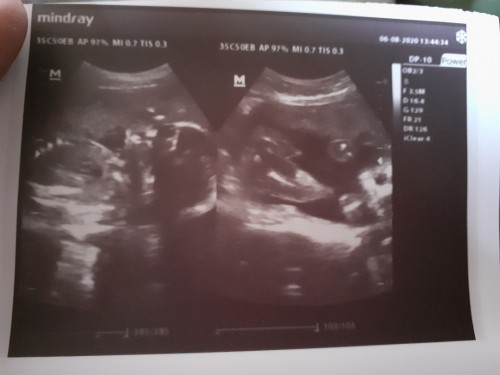 25weeks