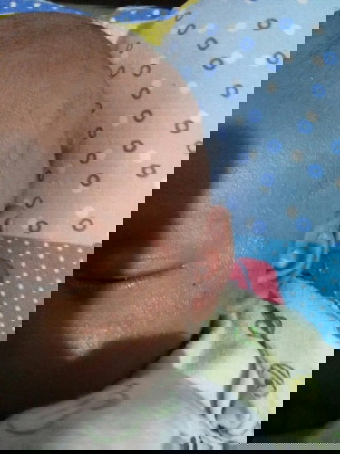 cara mengobati bintik merah pada ppi bayi