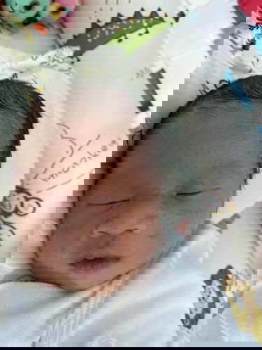 Newborn Baby Acne