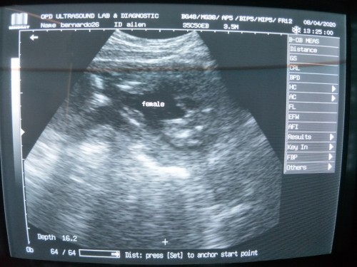 Ultrasound Gender
