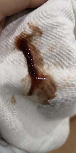 Pendarahan semasa hamil /polips endometrium