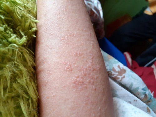 gatal seperti biduran saat hamil 36 Week