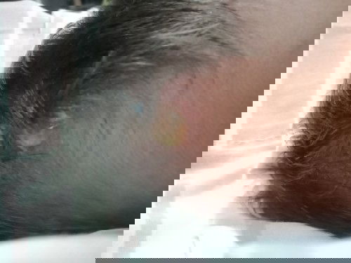 Blister on baby's head