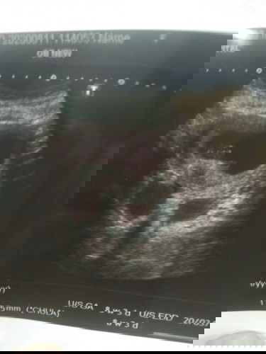 แบบนี้มีโอกาศจะเป็นแฝดมั้ยคะ ไปซาวด์รพ.หมอไม่ได้บอกอะไรเลย เห็นแผ่นซาวด์แล้วแอบตกใจ😅