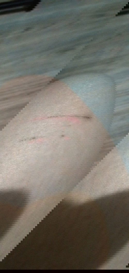 Cat scratch during pregnancy