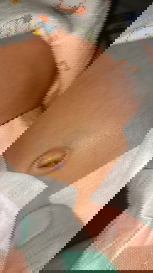 หนองในสะดือ