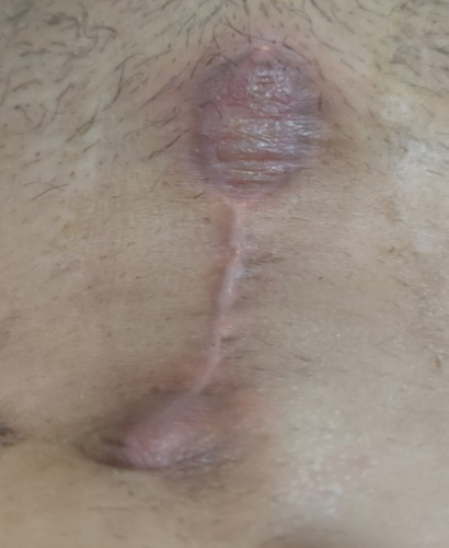 CS Wound problem