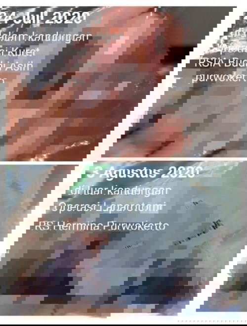 Selamat Jalan 2 Malaikat Kecilku  (Hamil di dalam rahim dan diLuar Rahim) {11 Agustus 2020)