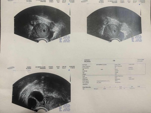 อัลตราซาวด์ตอน5weeks 1 Days