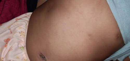 ผื่นเเดงน้อง