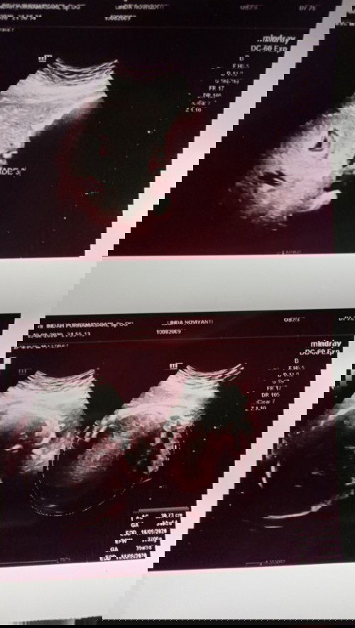 placenta bolong uk 36 weeks