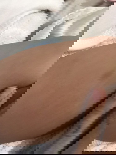 insect bite