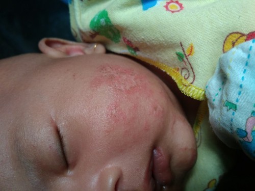 ruam pipi