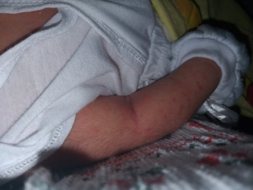 Baby Rashes