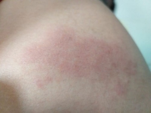 ผื่นคัน