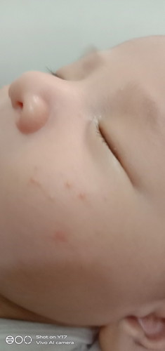ano pwede ipahid sa rashes ni baby