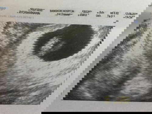 ภาวะแท้งคุกคาม