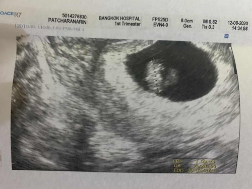 ภาวะแท้งคุกคาม