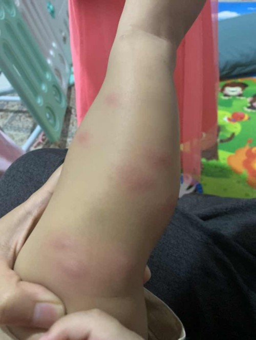 Ada siapa tahu ni kena gigit dengan serangga apa ye?