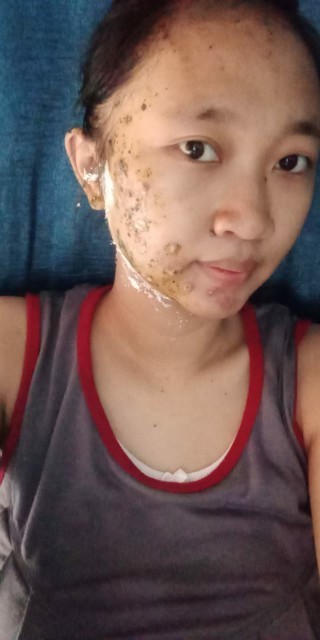 Sakit cacar akan pengaruh ke janin ga ya ?