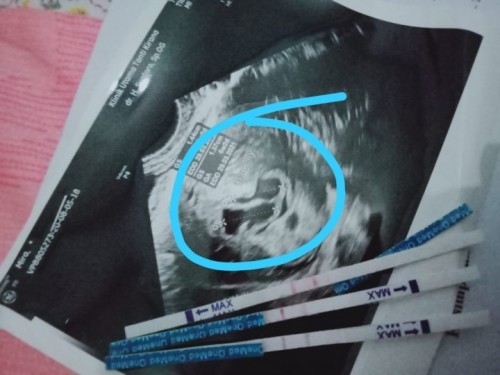 USG transvaginal
