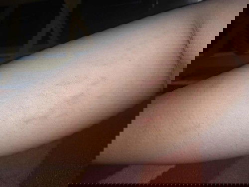 Stretchmark