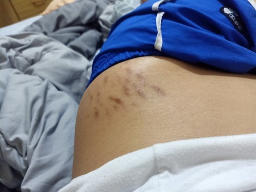 สะโพกแตกแบบนี้นานมั๊ยกว่าจะเป็นสีขาว?