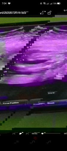 ULTRASOUND