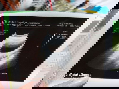 hasil usg berbeda dengan hpht bidan.