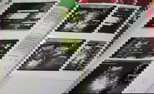 Pendarahan HPL Berubah 3x USG 31 agustus, USG ke 4 HPL jadi 18 Agustus