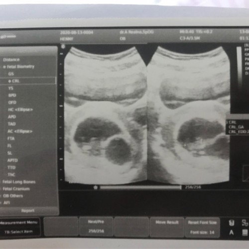 Ketika USG 2 bulan kehamilan terdapat 2 kantung