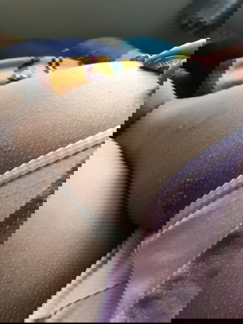 Nấm da (bầu 37w)