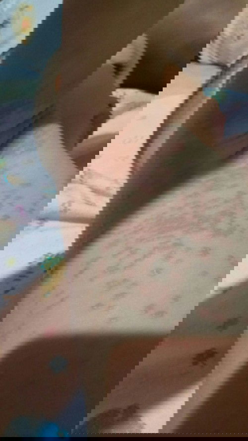 Bintik2 merah setelah demam