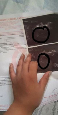 No fetal seen at six weeks