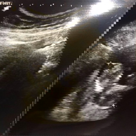 รกเกาะต่ำ ท้องแรก