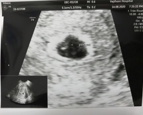 เลือดออกขณะตั้งครรภ์