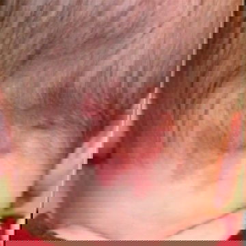 tanda merah di kepala bayi